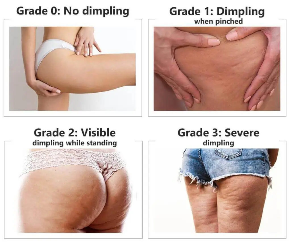 Representation of the stages of cellulite development Tetbury